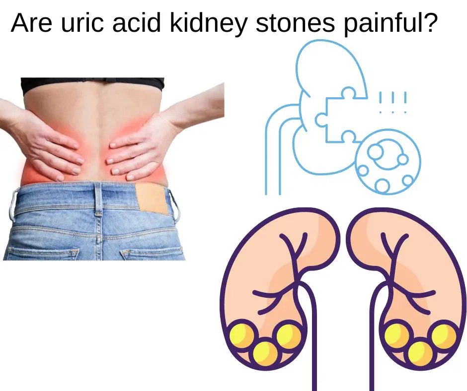 ¿Son dolorosos los cálculos renales de ácido úrico?