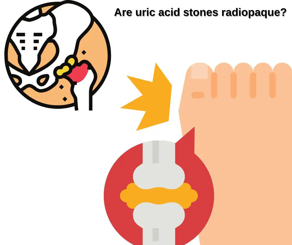 São pedras de ácido úrico radiopaque?