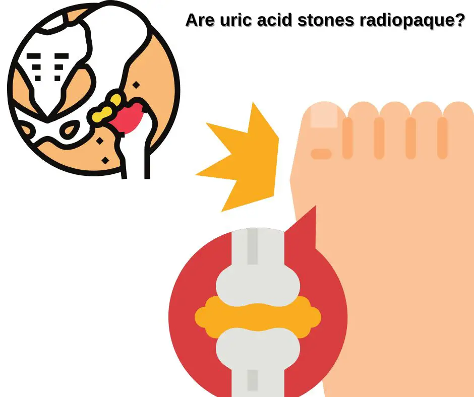 Zijn urinezuurstenen radiopaak?