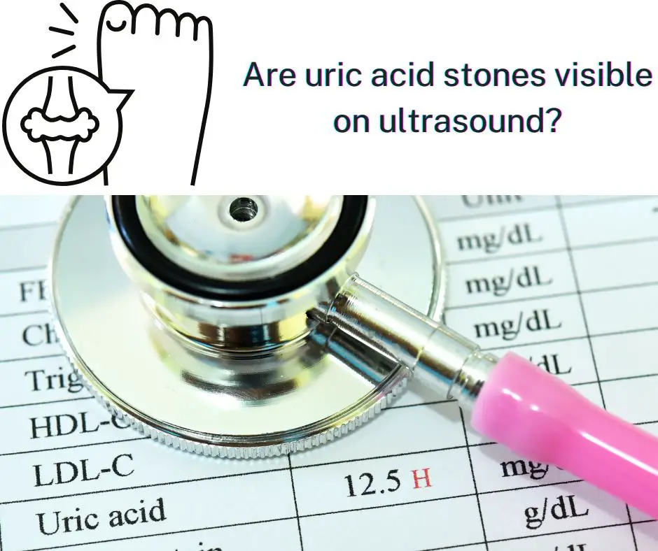 Are uric acid stones visible on ultrasound?