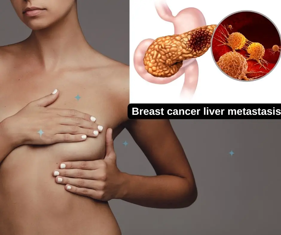 Breast cancer liver metastasis